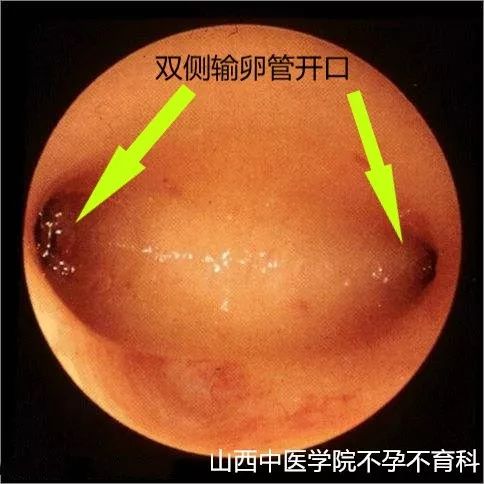 不孕症宫腔镜,不孕症的微创手术