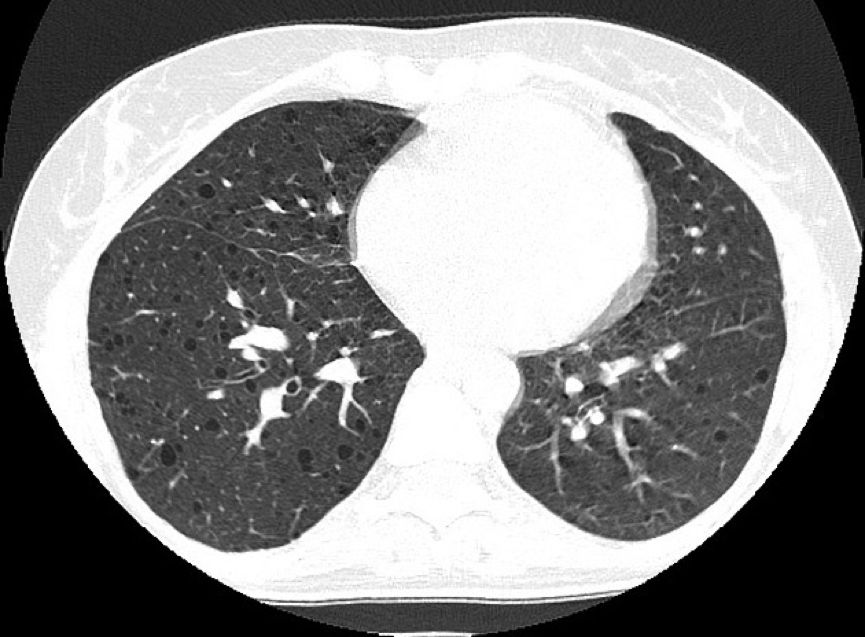 双肺上叶胸膜下见薄壁空腔正常吗,双肺多发类圆形薄壁透亮影严重吗