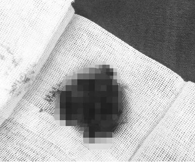 小伙咳嗽有痰怎么回事,一小伙咳嗽咳出肺部组织