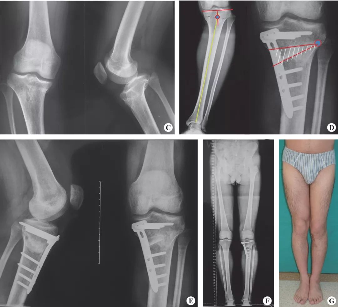 taylorswift支架,taylor外固定支架