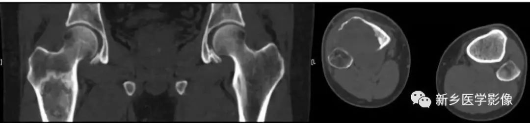 骨骼疾病怎么调理最有效,骨骼坏死最佳治疗方法