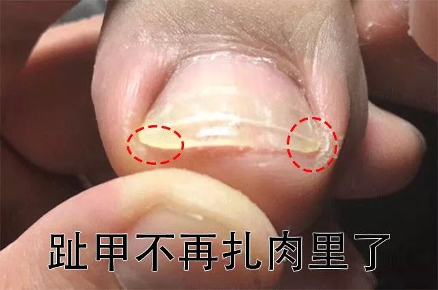 小脚趾甲长在肉里一碰就疼怎么办,指甲扎到肉里怎么处理