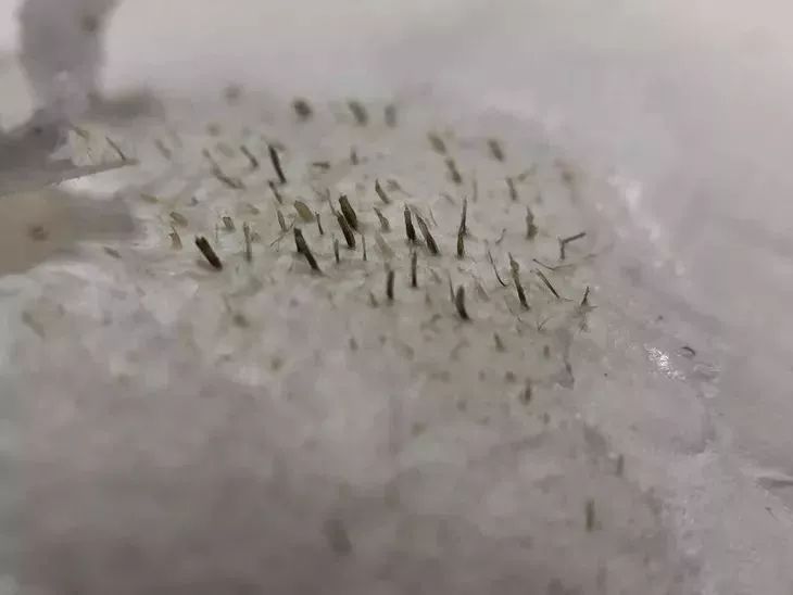 又爽又恶心的去黑头方法来了！5分钟将你10年的黑头白头连根拔起！