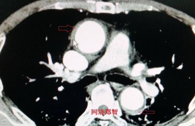 主动脉夹层cta能扫描出来吗,急性主动脉夹层cta影像诊断与鉴别