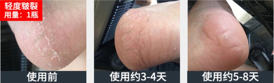 足部护理加长加热脚套,足部护理脚趾套品牌