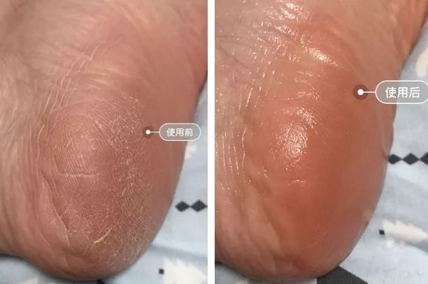 足部护理加长加热脚套,足部护理脚趾套品牌