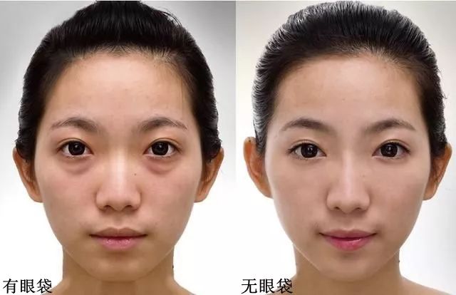 眼袋松弛下垂最快解决方法,严重眼袋下垂松弛怎么恢复