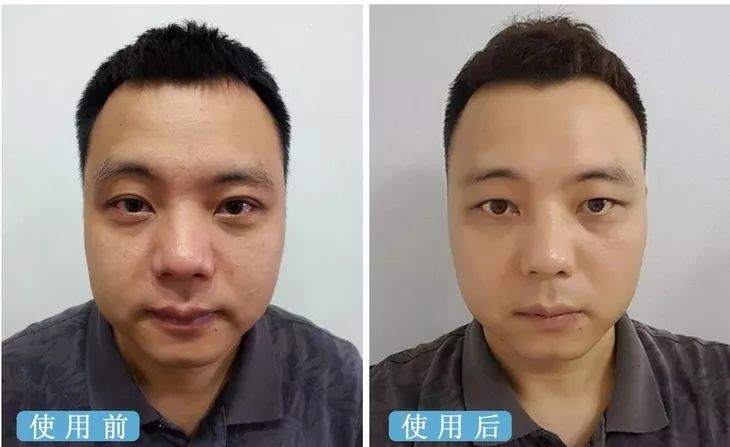 德国变态震动棒，啪啪啪间抚平眼袋、黑眼圈！不用开刀，就能让你年轻十岁！