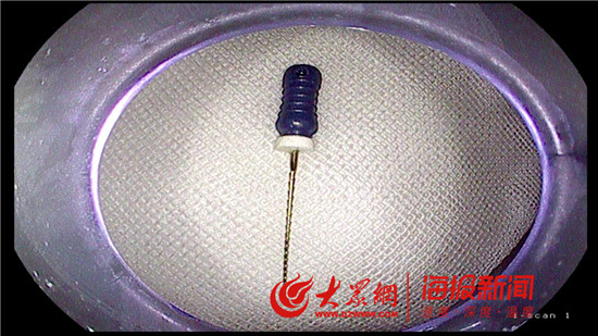 胃内“根管锉”险象环生淄博昌国医院妙手化险为夷