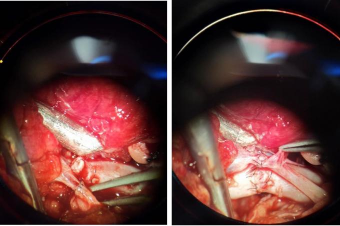 小腿部分断裂保守治疗,小腿离断再植康复训练