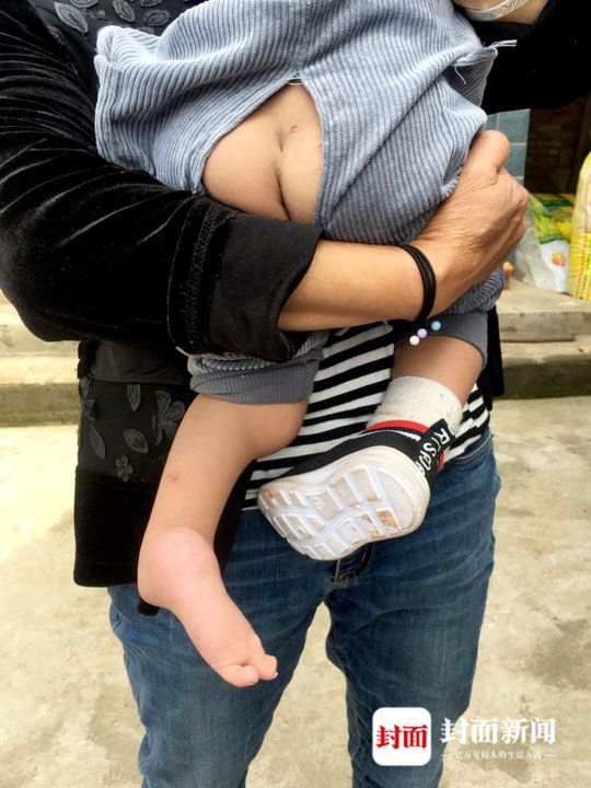 泰安漏诊畸形儿,产检正常却生出畸形儿