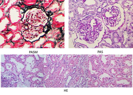 感冒引起血尿怎么回事,感冒了肉眼看见血尿什么原因