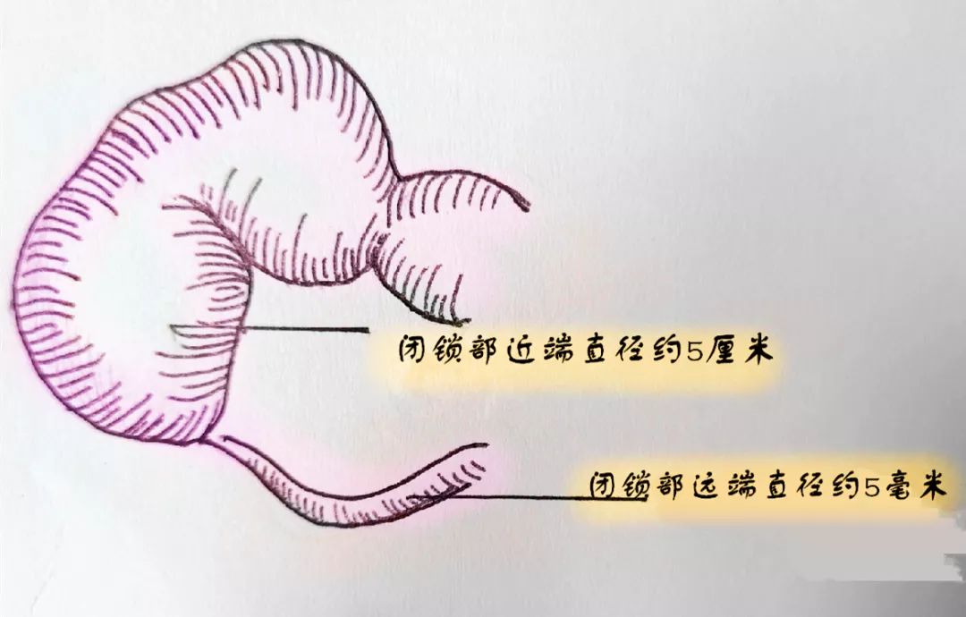 29周孩子肠扩张,在妈妈肚子里面的宝宝生出来了吗