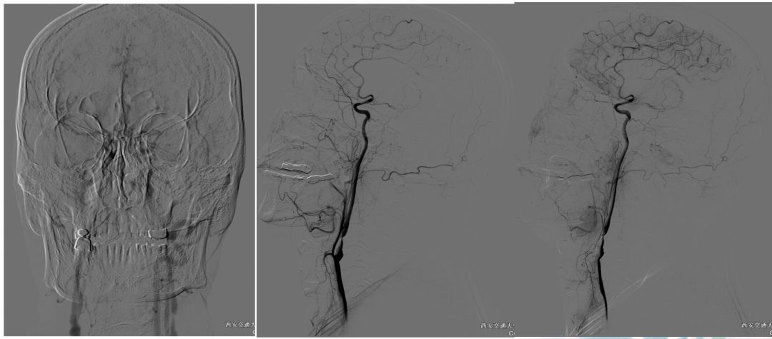 径技·例量|25期：再灌注出血—防不胜防