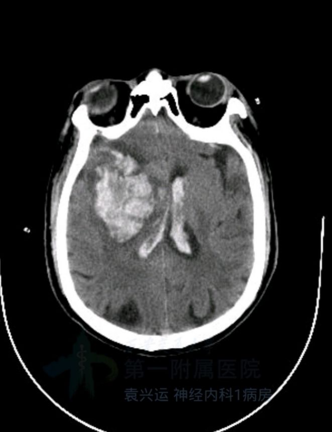 径技·例量|25期：再灌注出血—防不胜防