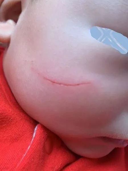 面部伤口美容缝合后注意事项,面部美容缝合视频