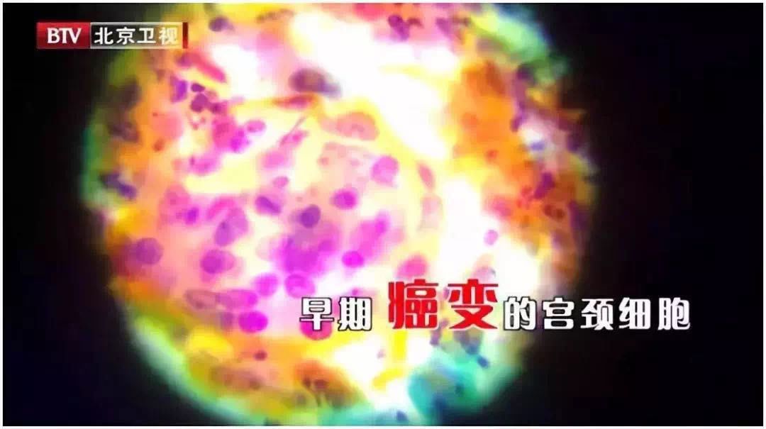 细菌病毒感染导致癌症,20多种癌症