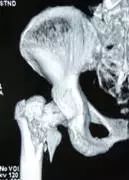 老年人股骨颈骨折康复教程,70岁股骨颈骨折保守治疗成功案例