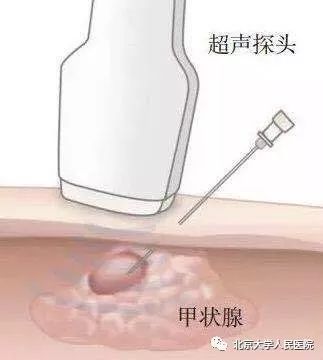 甲状腺病知识宣传周,甲状腺知识宣传周文章