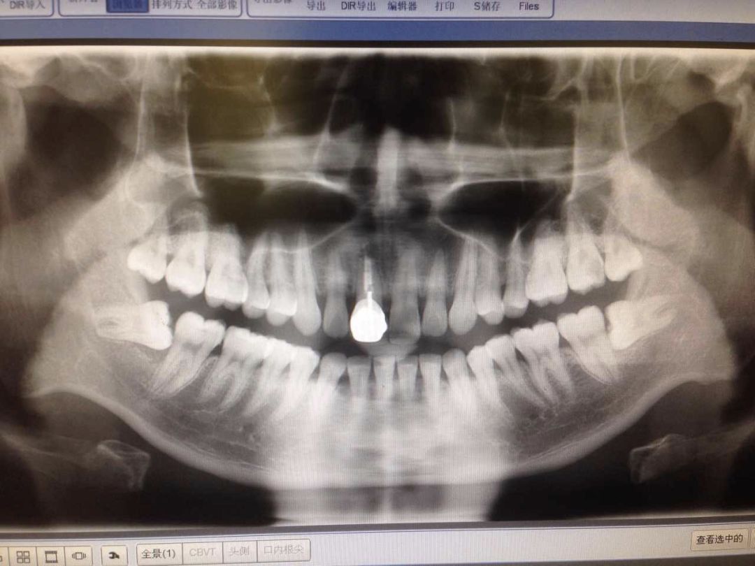 根管治疗没那么可怕,根管治疗有什么意义吗