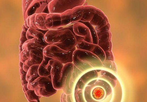 放屁太多确诊肠癌,女子总是放屁患上肠癌晚期