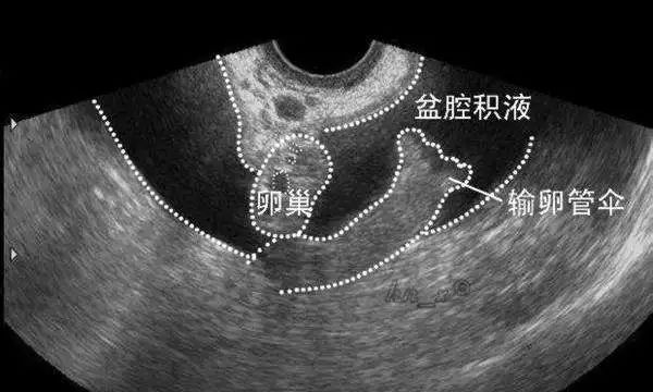 宫颈糜烂是不是妇科病最严重的,妇科宫颈糜烂怎样能治好