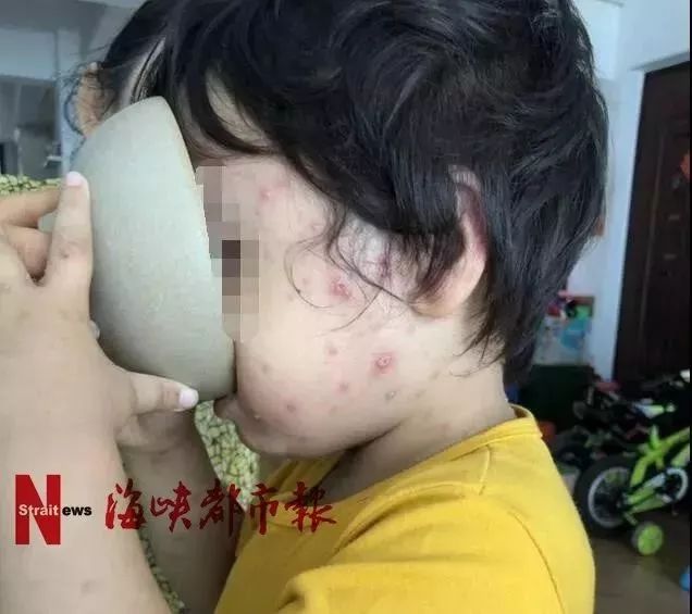 今年手足口病高发年,手足口病早期重症病例的三大表现