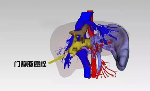 肝癌合并门静脉癌栓怎么办,纳米刀成对付癌中王的新利器