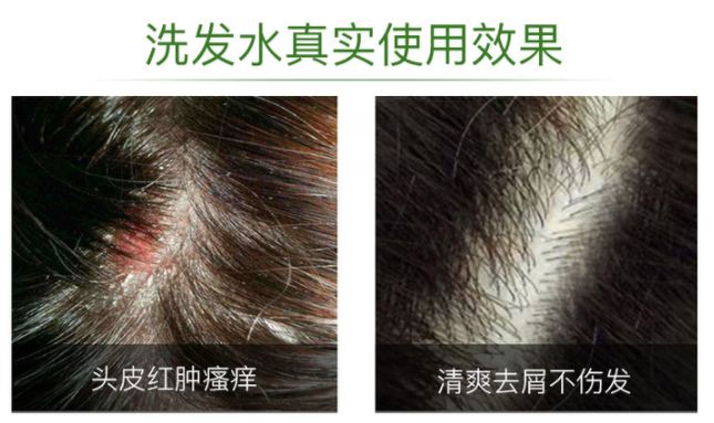 头皮除螨虫神器哪种好用,头屑头油清除神器第一名