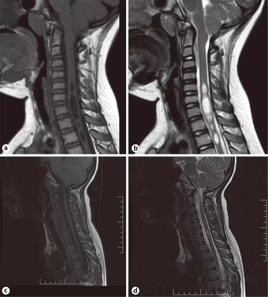Chiari畸形1型伴脊髓空洞症能自愈吗？