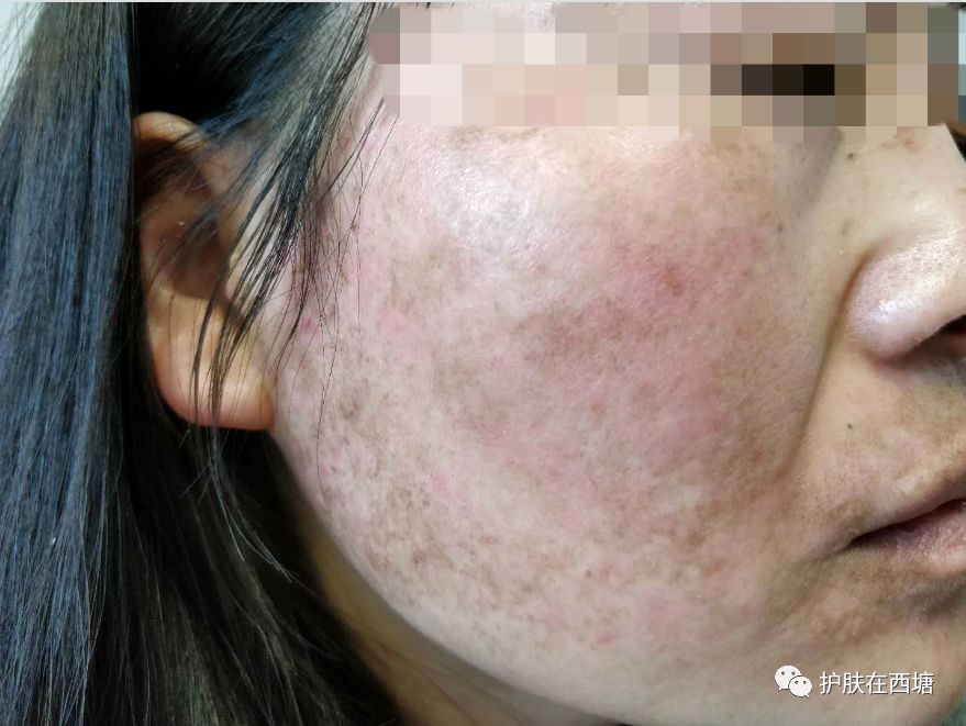 激素依赖性皮炎怎么才能彻底治好,激素依赖性皮炎好了以后怎么护肤