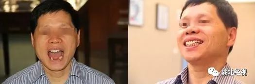 武汉种植牙齿需要多少钱,武汉种植牙齿一颗要多少钱