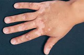 健康中国白癜风能治吗,白癜风不可怕请科学对待诊室日常