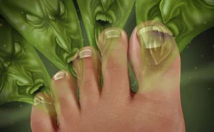 夏季脚气特别痒怎么办,夏天脚气高发怎么治疗