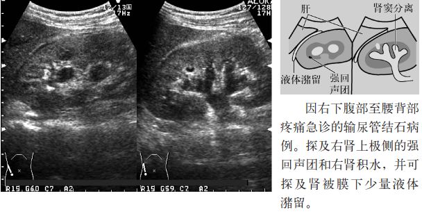 肾结石图片输尿管结石症状,输尿管上段结石超声碎石危害大么