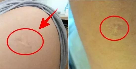 胳膊上的小圆疤是什么,手臂的疤是怎么形成的