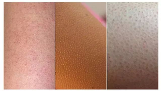 鸡皮肤永久消除,37天快速祛鸡皮肤