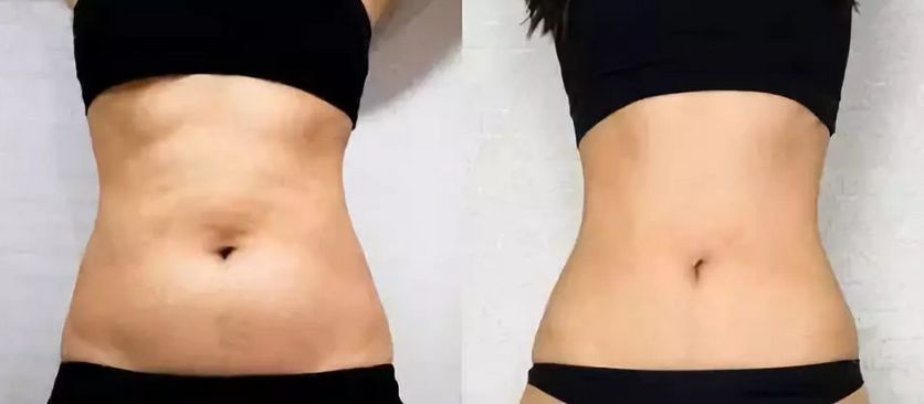 无需抽脂的韩国溶脂仪，2周抚平橘皮，腰围还瘦3cm