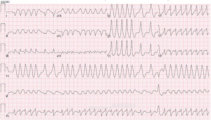 预激房颤,房颤没症状需要射频消融吗