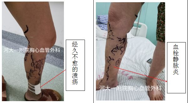 筋疙瘩怎么去除,筋疙瘩好治吗