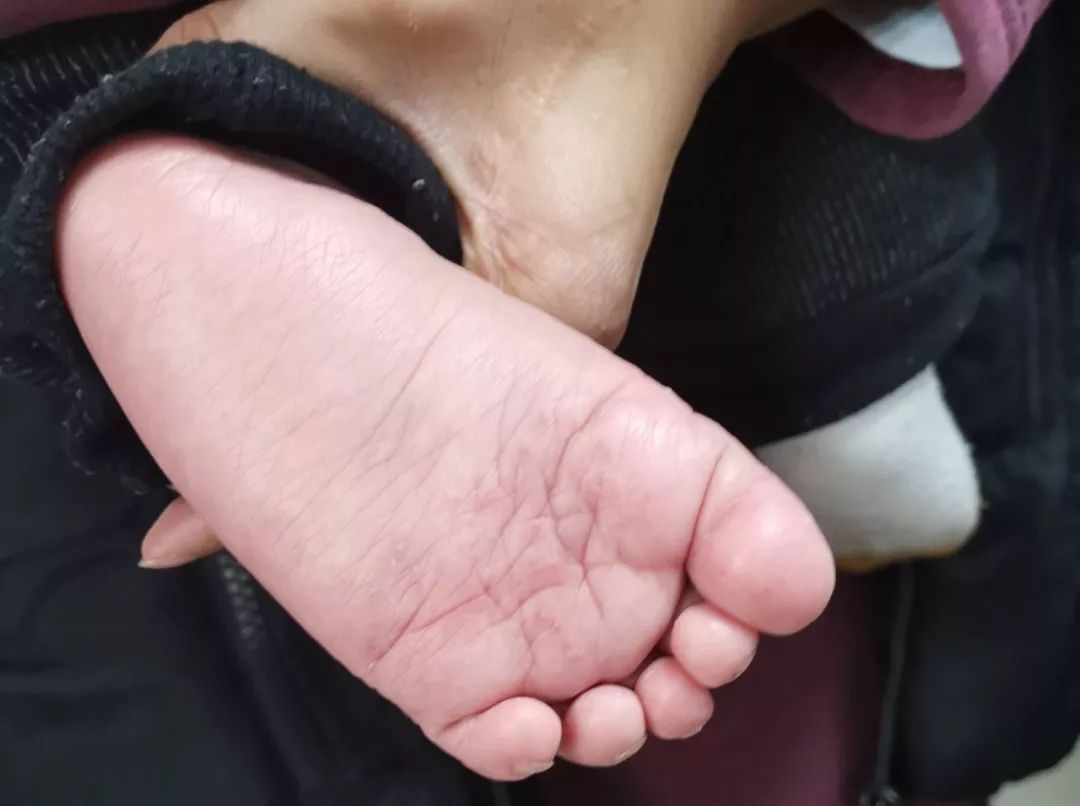 8个月的宝宝竟然得了“香港脚”！医生：梅雨季尤其要多注意