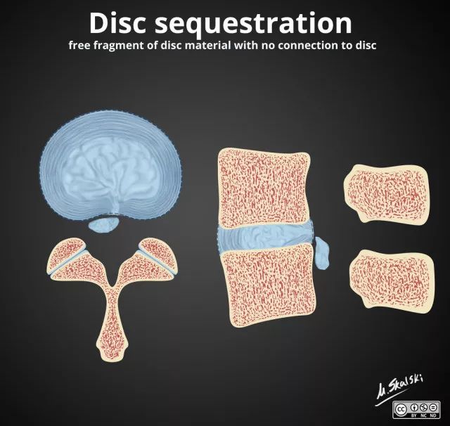 椎间盘膨出、突出、脱出如何鉴别，几幅图让你一目了然