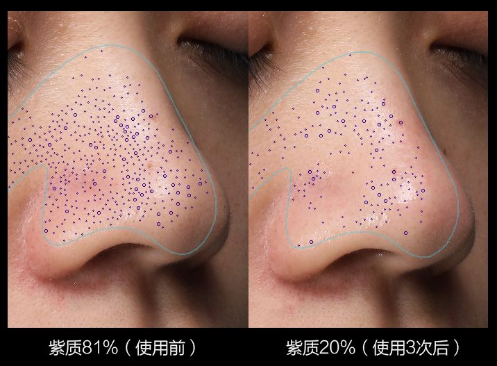 黑头用黑头膏为什么去不掉黑头,清洁黑头推荐用黑头仪还是黑头铲