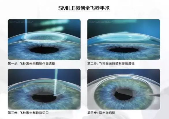 近视1200度可以做飞秒激光手术吗,近视手术全激光和飞秒有什么区别