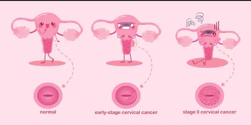 中国hpv疫苗研制成功,hpv疫苗是如何研制的