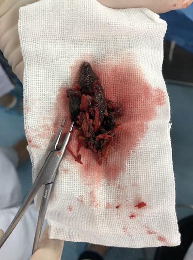 女童下身流脓四年，原来里面塞了果肉