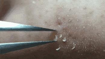 一抹吸出黑头,鸡蛋清除黑头