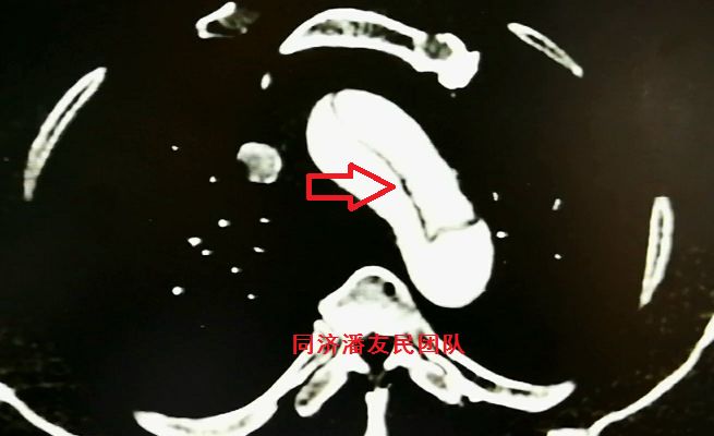 主动脉夹层如何快速确诊,确诊主动脉夹层最可靠办法