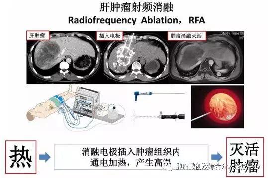 大咯血的抢救药物,支扩栓塞止血后大咯血还会复发吗