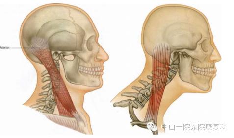筋膜的康复训练方法,12条筋膜链解析及治疗手法